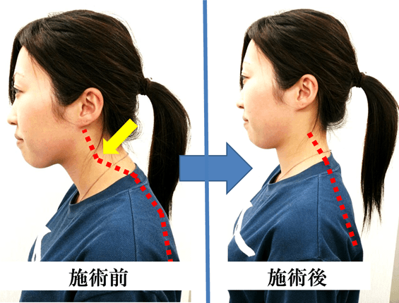 ���̂€�͂����̉@����Ŏ{�p�O��̎ʐ^